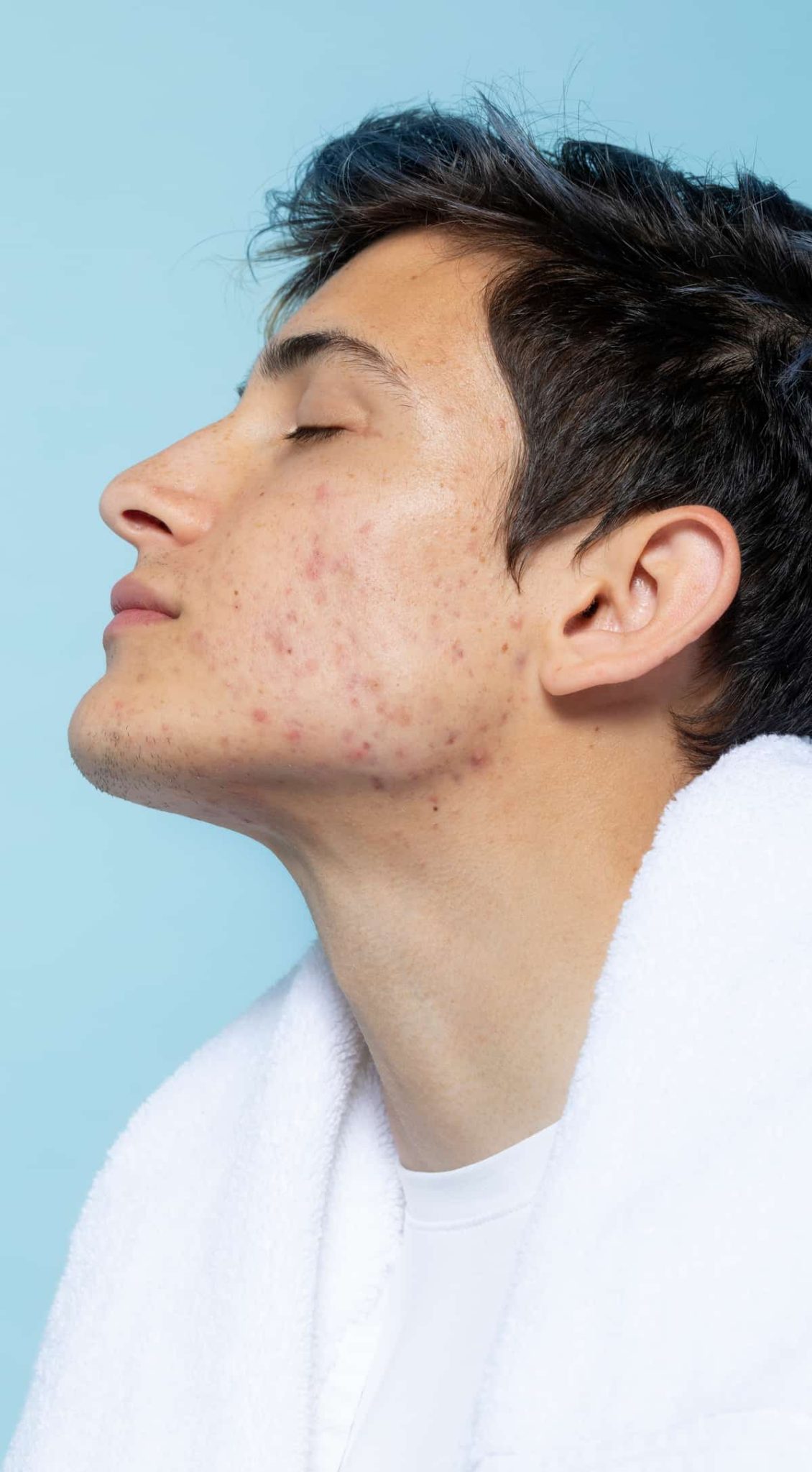 Pockmarks Causes and Solutions PDCosmetics