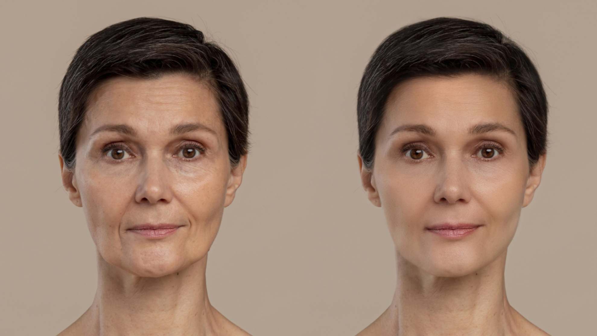 Profhilo Before and After