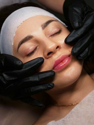 Juvederm Vertical Lip Lines: Before & After Results