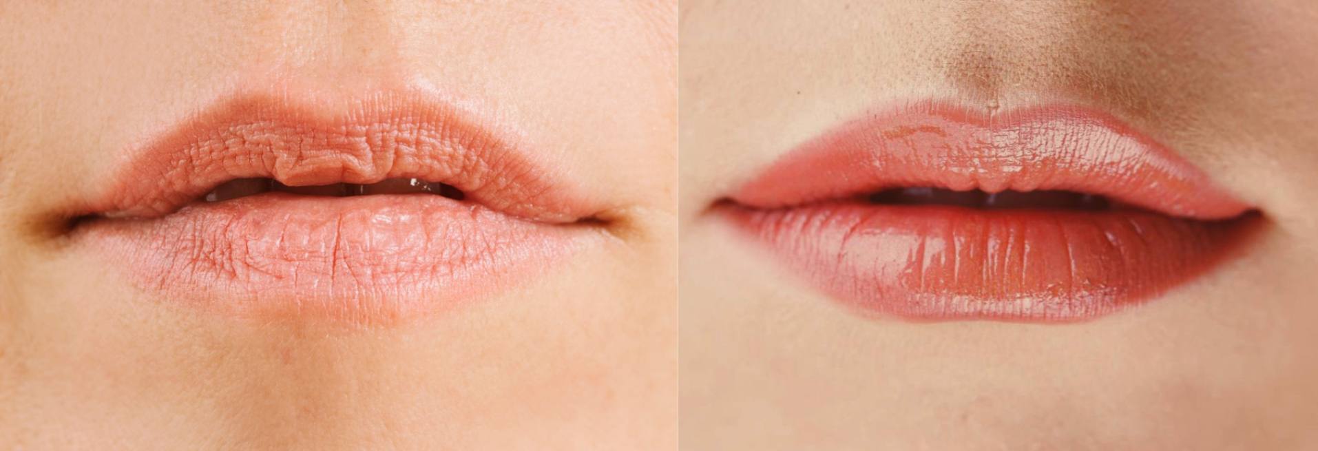 Best Filler for Lip Lines and Wrinkled Lips