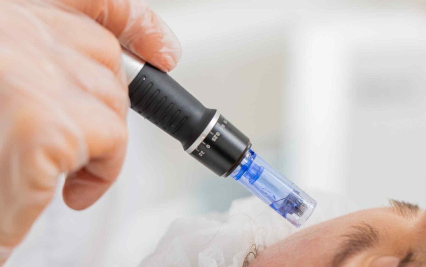 Microneedling Lips with Hyaluronic Acid