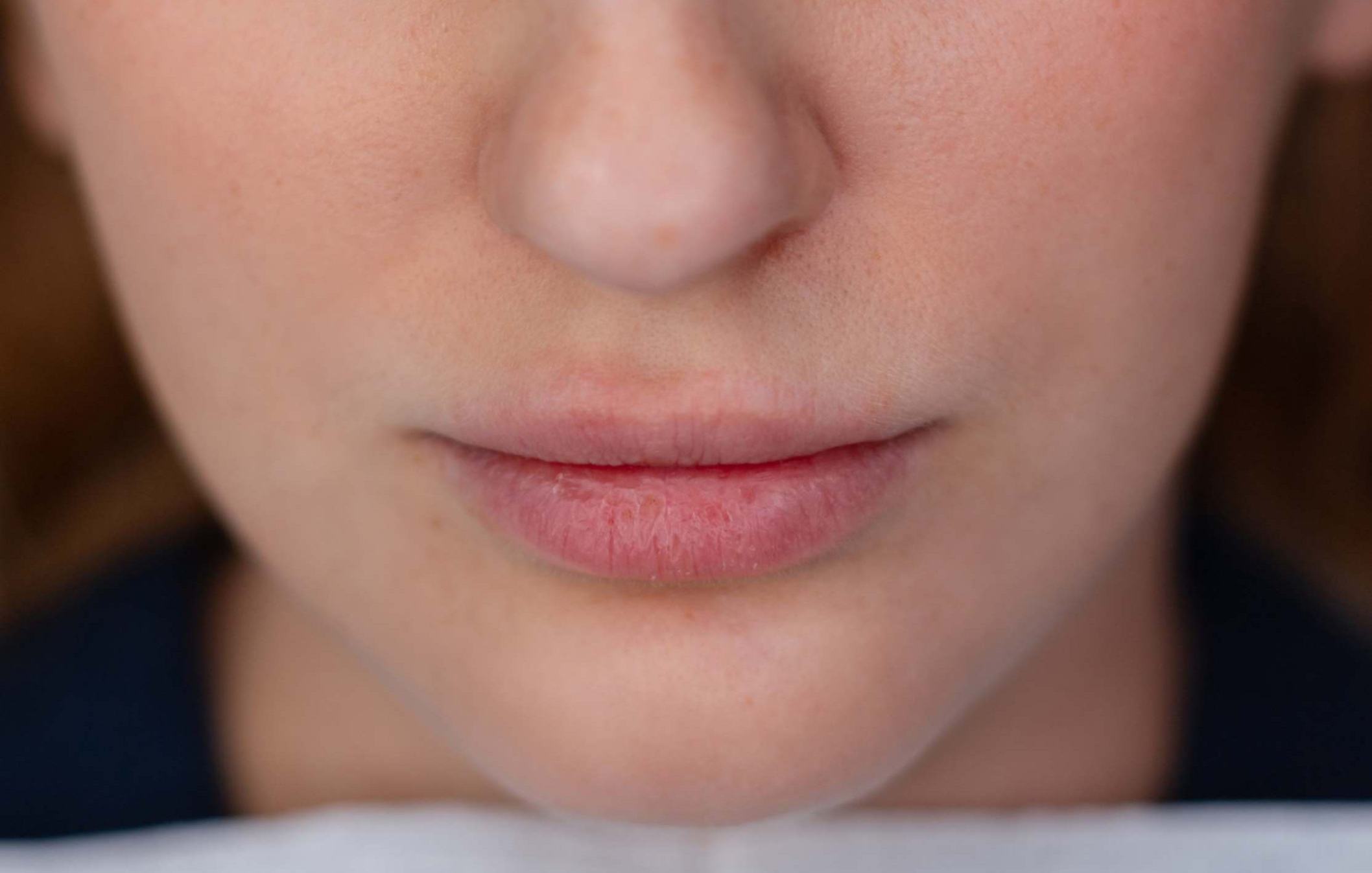 Lip Filler Migration Inside Lip