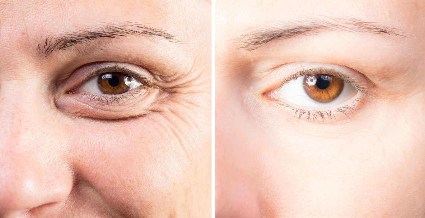 Results of Nucleofill Eyes Gone Wrong Before and After