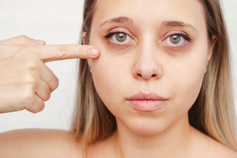 Causes of Dark Circles and Bags Under the Eyes