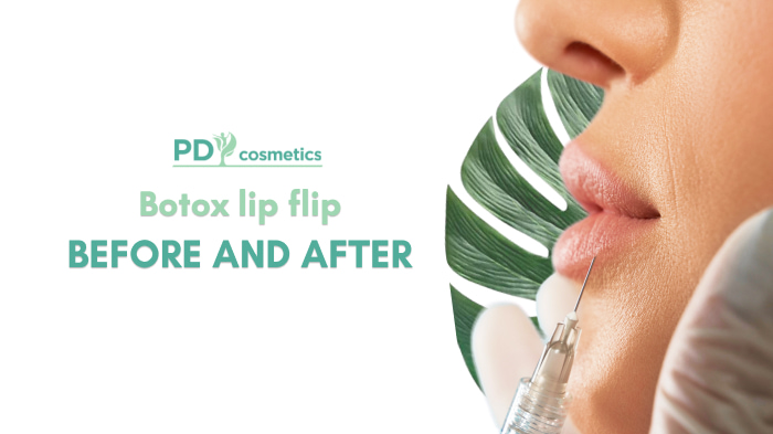 botox lip flip before and after
