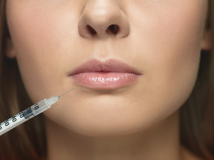Restylane Lip Augmentation procedure for young woman