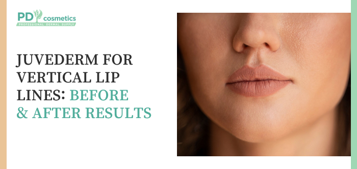 Juvederm for Vertical Lip Lines: Before & After Results