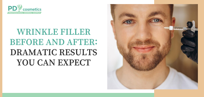 Wrinkle Filler Before and After