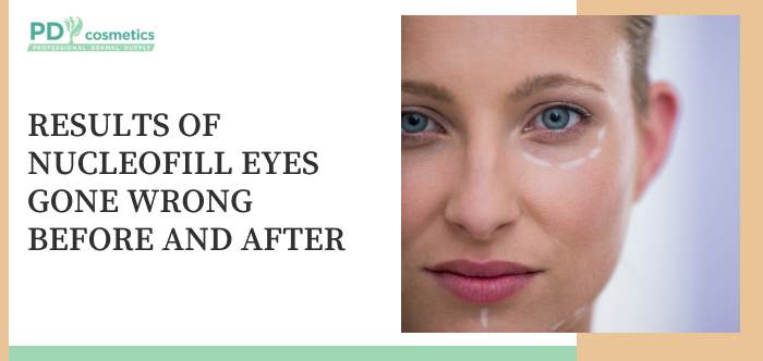 Results of Nucleofill Eyes Gone Wrong Before and After