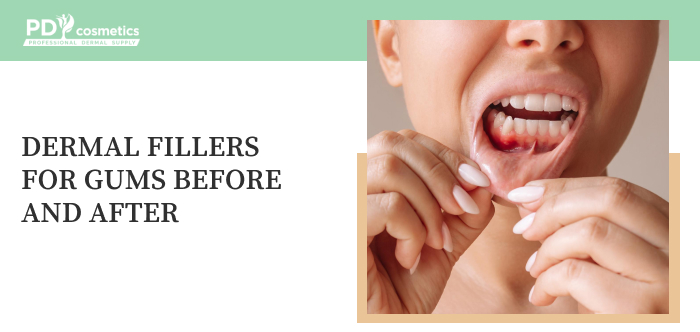 Dermal Fillers for Gums Before and After