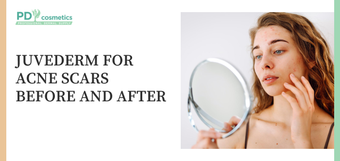 Juvederm for Acne Scars Before and After