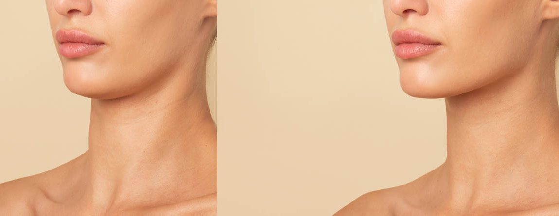 A More Defined Chin with Juvederm