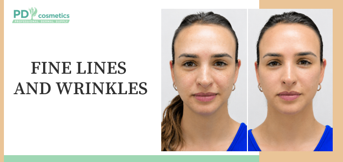 fine lines and wrinkles