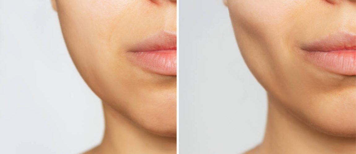 Juvederm For Jowls