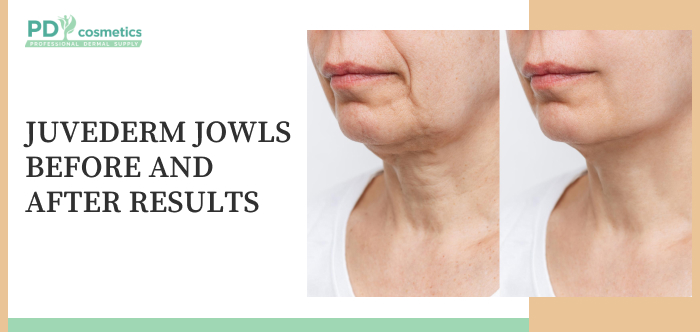 Juvederm Jowls Before and After Results
