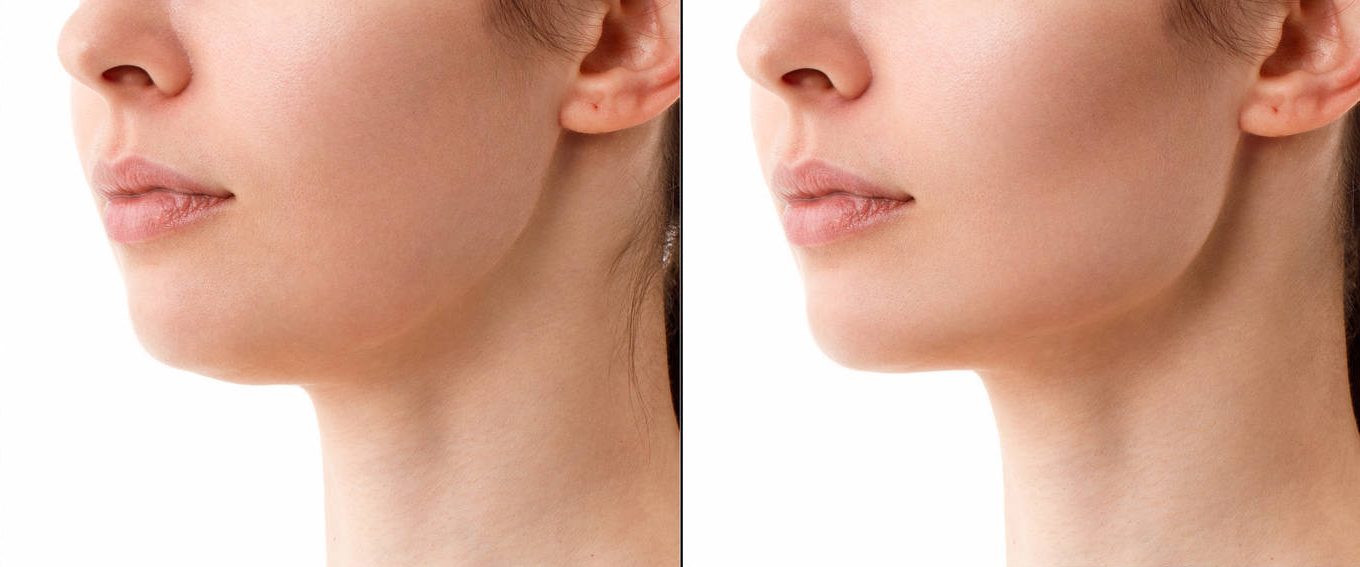 Reduced Sagging skin