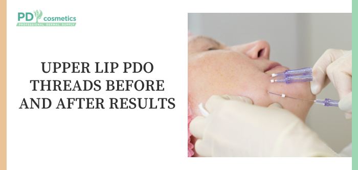 Upper Lip PDO Threads Before and After Results