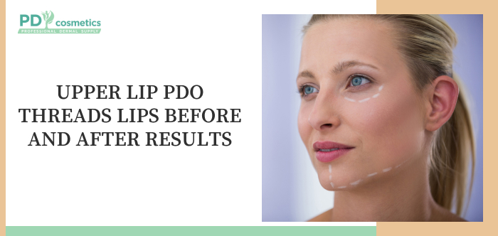 Upper Lip PDO Threads Lips Before and After Results